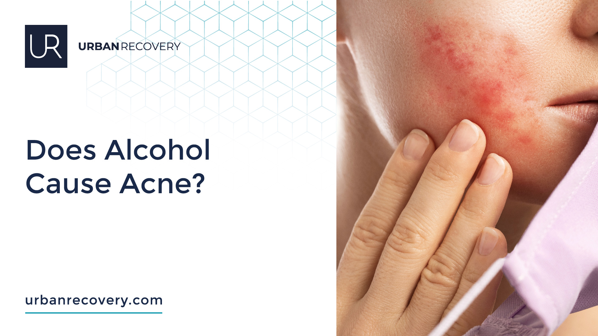 Does Alcohol Cause Acne?